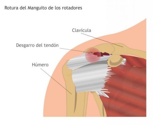 Cirugía de hombro Guadalajara Cirugía de hombro Guadalajara Cirugía de hombro Guadalajara desgarro manguito rotador anatom  a