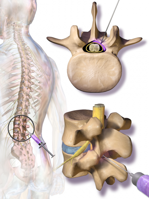 Hernia Discal Operación ¿y sus Riesgos?