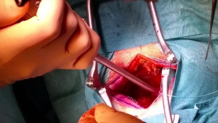 Hernia Discal Operación ¿y sus Riesgos? hernia discal operación ¿y sus riesgos? Hernia Discal Operación ¿y sus Riesgos? operaci  n hernia discal 1