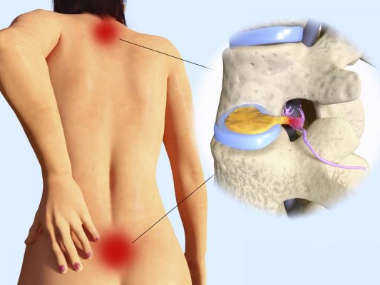 Prevención de hernias discales