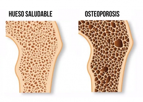 Osteoporosis en Edad Media osteoporosis en edad media Osteoporosis en Edad Media osteoporosis
