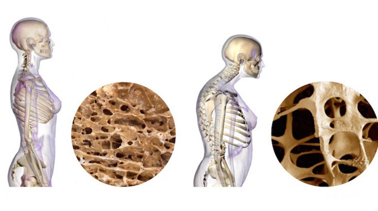 Osteoporosis en Edad Media