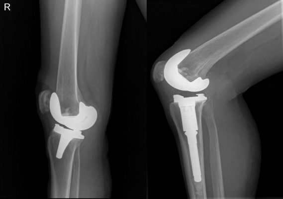 Cirugía de Rodilla en qué casos utilizar prótesis en rodilla En qué Casos Utilizar Prótesis en Rodilla pr  tesis rodillas