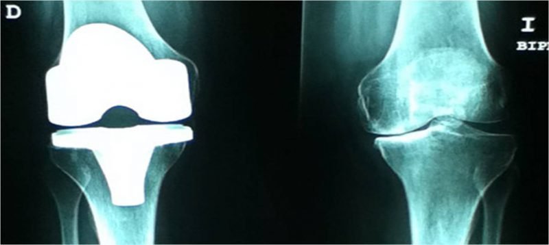 En qué Casos Utilizar Prótesis en Rodilla en qué casos utilizar prótesis en rodilla En qué Casos Utilizar Prótesis en Rodilla protesis rodilla