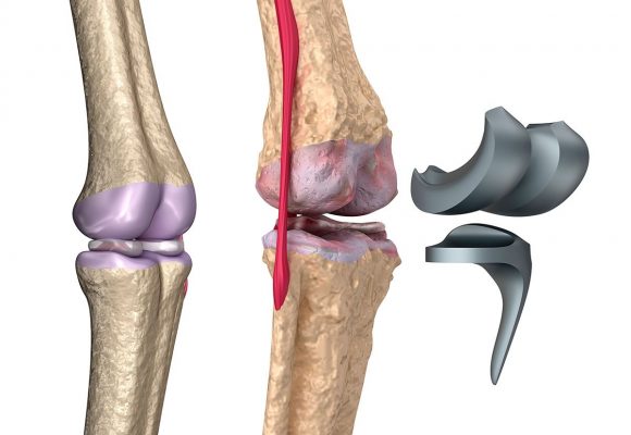 En qué Casos Utilizar Prótesis en Rodilla