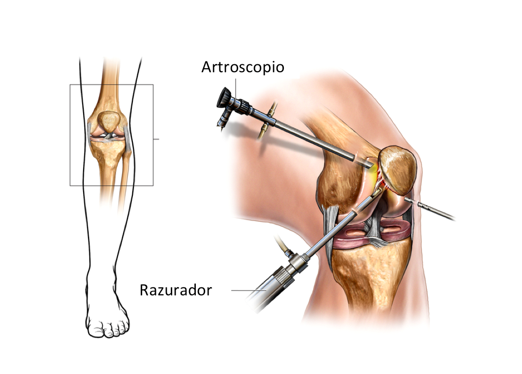 Cirugia de rodilla guadalajara