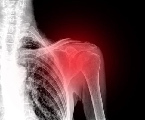 Las Lesiones en los Hombros Médico ortopedista Médico ortopedista experto en cirugía de rodilla lesiones hombro 1 1