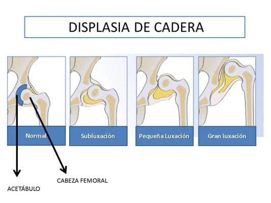 Cirugía de Cadera en Guadalajara Cirugía de Cadera en Guadalajara Cirugía de Cadera en Guadalajara luxacion de cadera 2