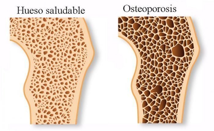 Médico Ortopedista realizando diagnóstico de osteoporosis